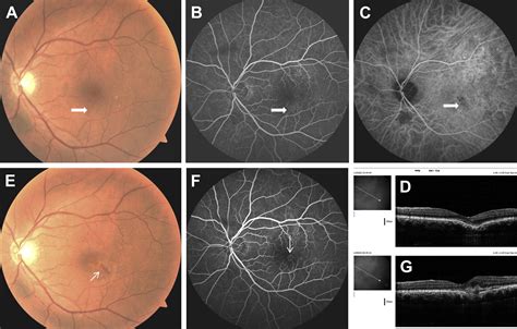 Focal Choroidal Excavation Complicated By Choroidal Neovascularization