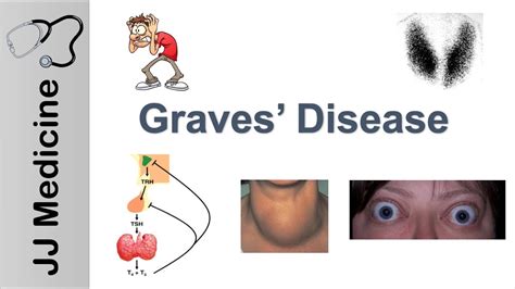 Graves Disease And Graves Ophthalmopathy Signs Symptoms Diagnosis And Treatment Youtube