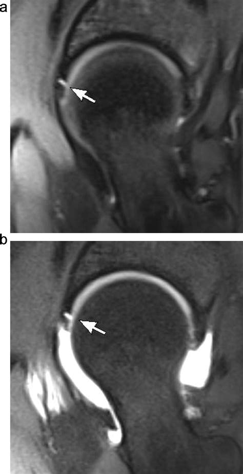 30t Conventional Hip Mr And Hip Mr Arthrography For The Acetabular