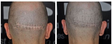 Pin On Hair Transplant Surgery And Its Side Effects