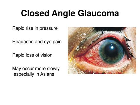 Symptoms of acute angle closure are severe ocular pain and redness, decreased vision, colored halos around lights, headache, nausea, and vomiting. PPT - ACUTE ANGLE CLOSURE GLAUCOMA PowerPoint Presentation ...