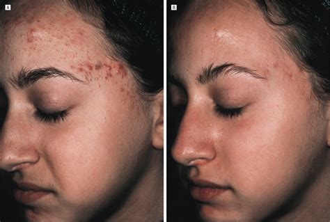 Successful Treatment Of Acne Vulgaris Using A New Method Results Of A