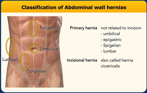 Ultrasound Of Groin Anterior Abdominal Wall Hernias Ultrasound My XXX