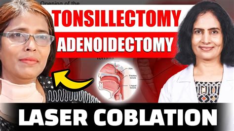Laser Coblation Tonsillectomy And Adenoidectomy Youtube