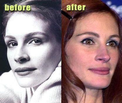 How Well Julia Roberts Plastic Surgery Was Perfomed Celebrity