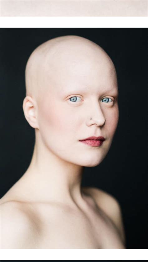 Beautiful Model With Alopecia Bald Head Women Going Bald Bald Women