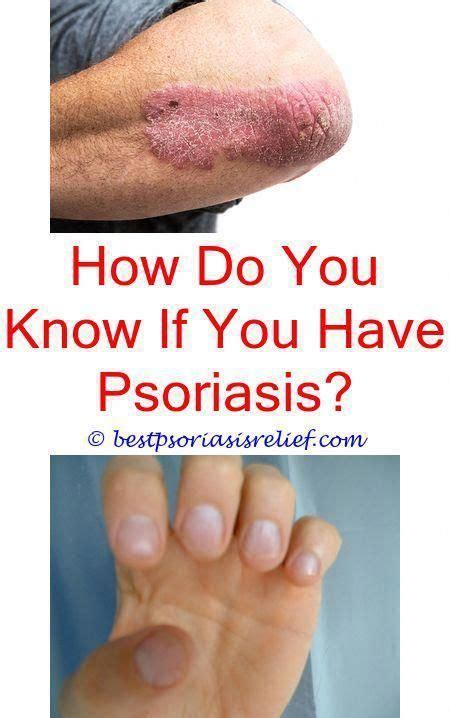 Pin On Psoriasis