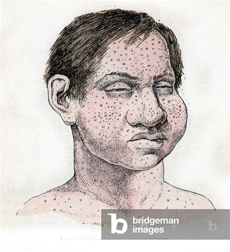 Representation Of The Characteristic Lesions Caused By Smallpox With A