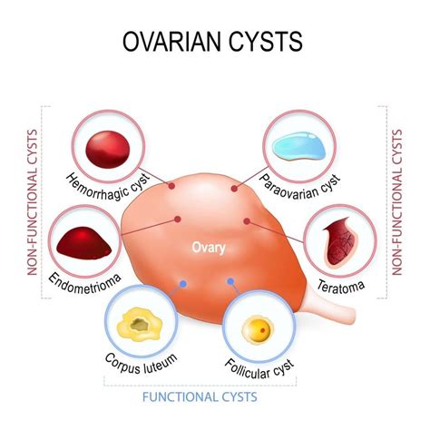 Should You Be Worried About An Ovarian Cyst Sunshine State Womens