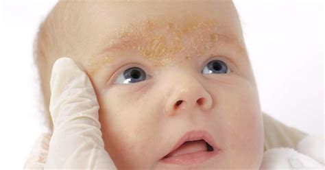Rash On A Baby S Face Pictures Causes And Treatments