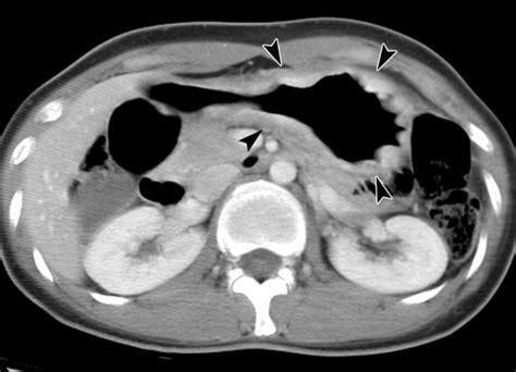 Ct And Pet In Stomach Cancer Preoperative Staging And Monitoring Of