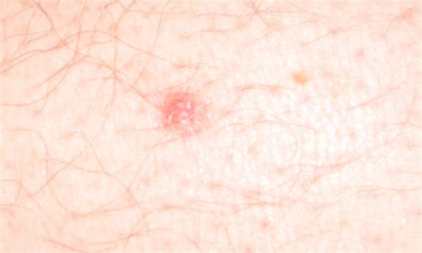 What Is Pearly Papules