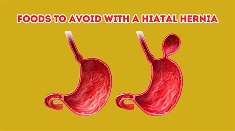 Foods To Avoid With A Hiatal Hernia Youtube