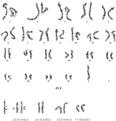 Gtw Banded Karyotypes Of Monosomy X And Xq Duplication On Patient 3