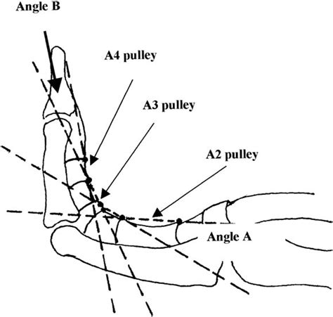 The A3 Pulley Journal Of Hand Surgery
