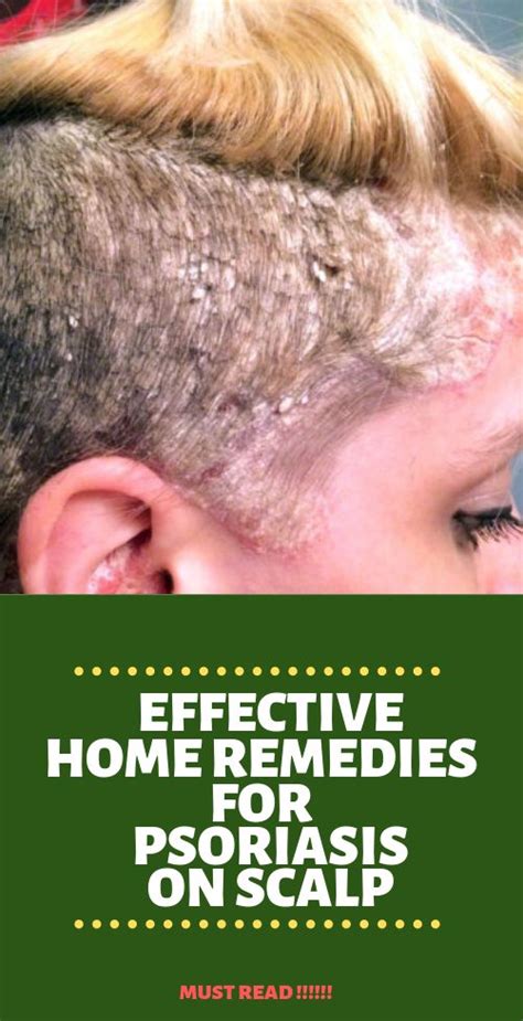 Home Remedies For Psoriasis On Scalp It Works Home Remedies For
