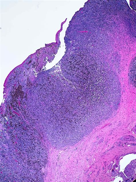 Pathology Outlines Mucosal Melanoma Genital Oral Sinonasal