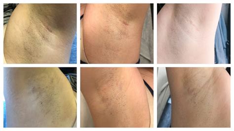 Laser Hair Removal Before After Underarms Blair Med Spa Hot Sex Picture