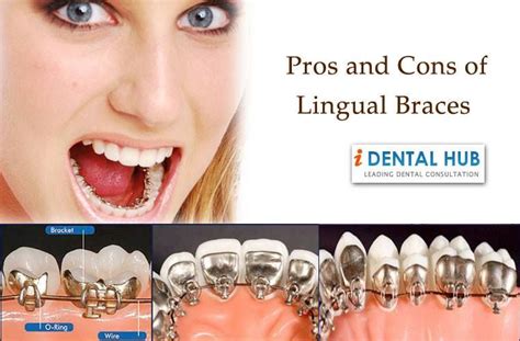 Pros And Cons Of Lingual Brace Lingual Braces Teeth Braces Teeth