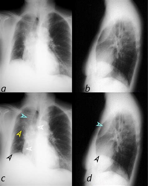 Cancer Chest X Ray Lungs