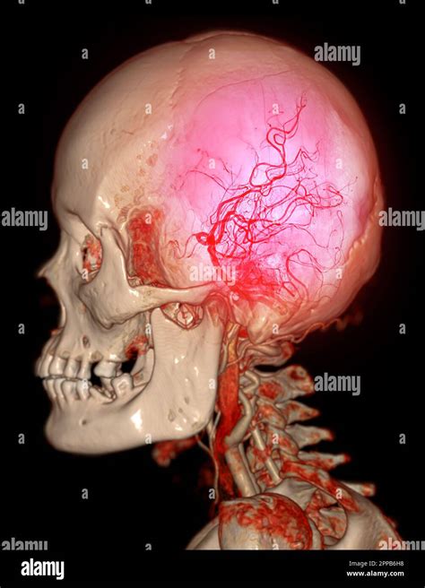 Cta Brain And Carotid Artery Or Ct Angiography Of The Brain 3d