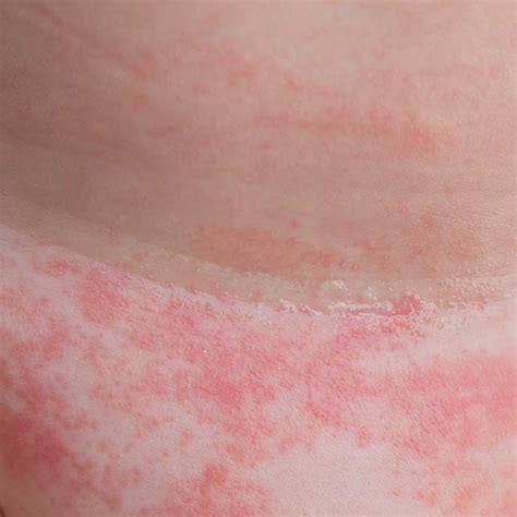 Dermatite Da Pannolino MOST Skincare