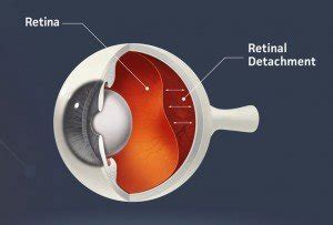 We did not find results for: Retinal Detachment & Retina Tear Treatment in Atlanta, GA ...