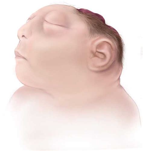 Información Sobre La Anencefalia Defectos De Nacimiento Ncbddd Cdc