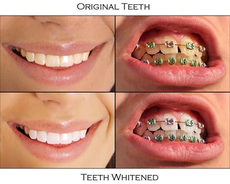 Let's take a more whether referring to those placed on the front of the teeth or braces attached to the rear, cleaning can this is even more relevant in terms of keeping the teeth white. How To Get White Teeth - Musely