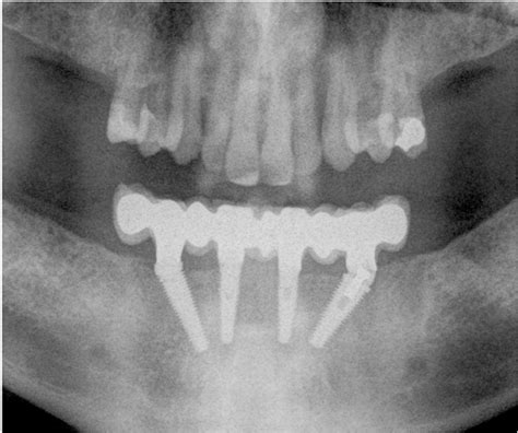 All On 4 In The Edentulous Mandible A Tilted Implant With Angulated