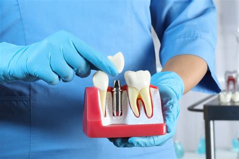 A Guide To The Dental Implant Restoration Process Sai Dental Care