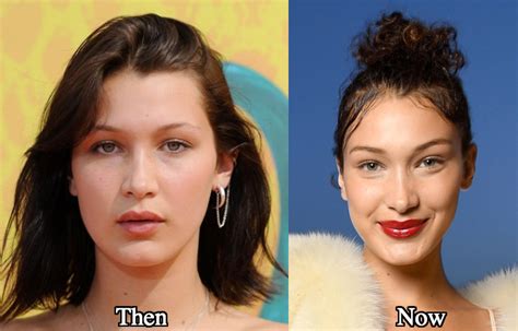bella hadid nose job before and after compare photos latest plastic surgery gossip and news