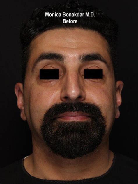 Before And After Upper Face And Temples Procedures In Newport Beach Ca Bonakdar Aesthetics