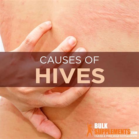 Hives Symptoms Causes And Treatment By James Denlinger