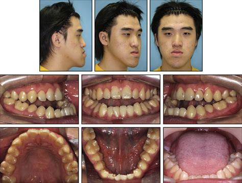 Class Iii Malocclusion Definition Overthrow Online Journal Photo Galery