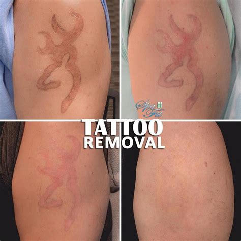 Our Another Happy Client Complete Tattoo Removal Can Be Seen In