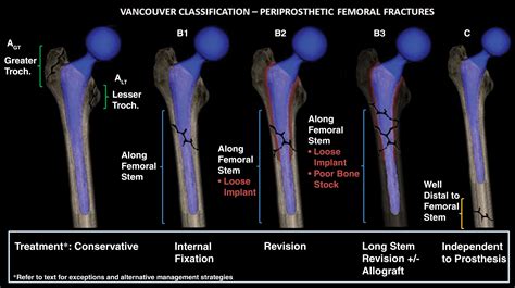 Periprosthetic Femoral Fractures In The Emergency Department What The