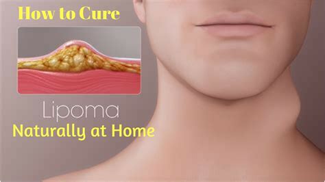 How To Treat Lipoma Without Surgery How To Cure Lipoma 5 Ways To Get
