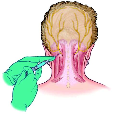 Greater Occipital Nerve Block For Acute Treatment Of Migraine Headache