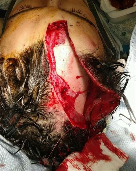 Extensive clean edge laceration injury to the scalp!! : medizzy