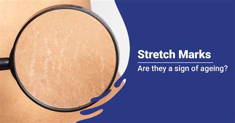 Stretch Marks Causes Treatment And Prevention