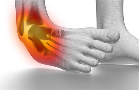 How To Fix A High Ankle Sprain Ankle Syndesmosis Injury Sport