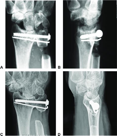 A Early Postoperative Radiography In Anteroposterior View B Early