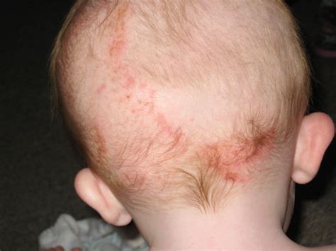 Rash On Back Of Head Pictures Photos