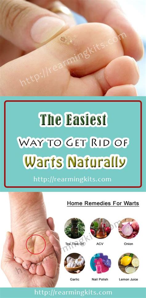 The Easiest Way To Get Rid Of Warts Naturally Home Remedies For Warts
