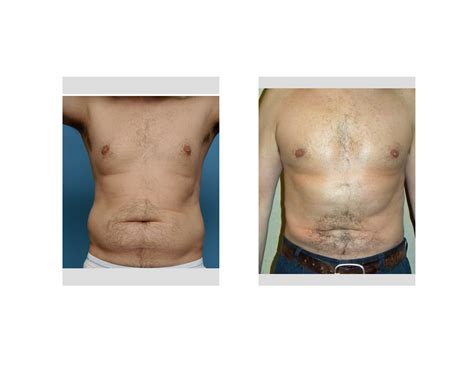 Case Study Realistic Male Abdominal And Love Handle Liposuction