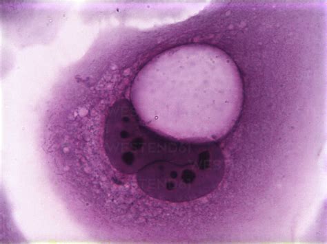 Koilocytes Squamous Epithelial Cells Altered By Human Papillomavirus