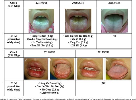 Figure 1 From Management Of Viral Oral Ulcers In Children Using Chinese