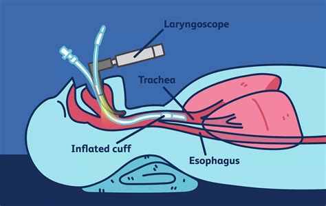 Complications Of Endotracheal Intubation Endotracheal Intubation