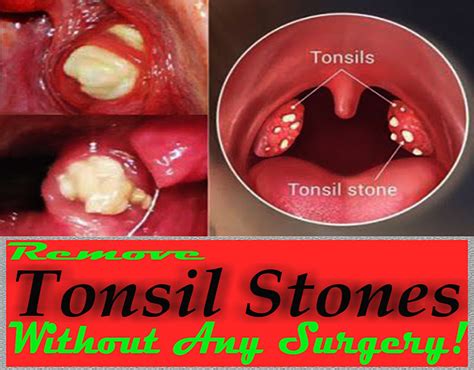 Remove Tonsil Stones Without Any Surgery On Behance